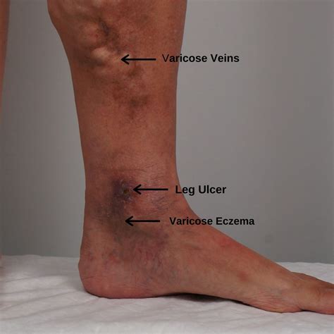 eczeme varicoase vasculare
